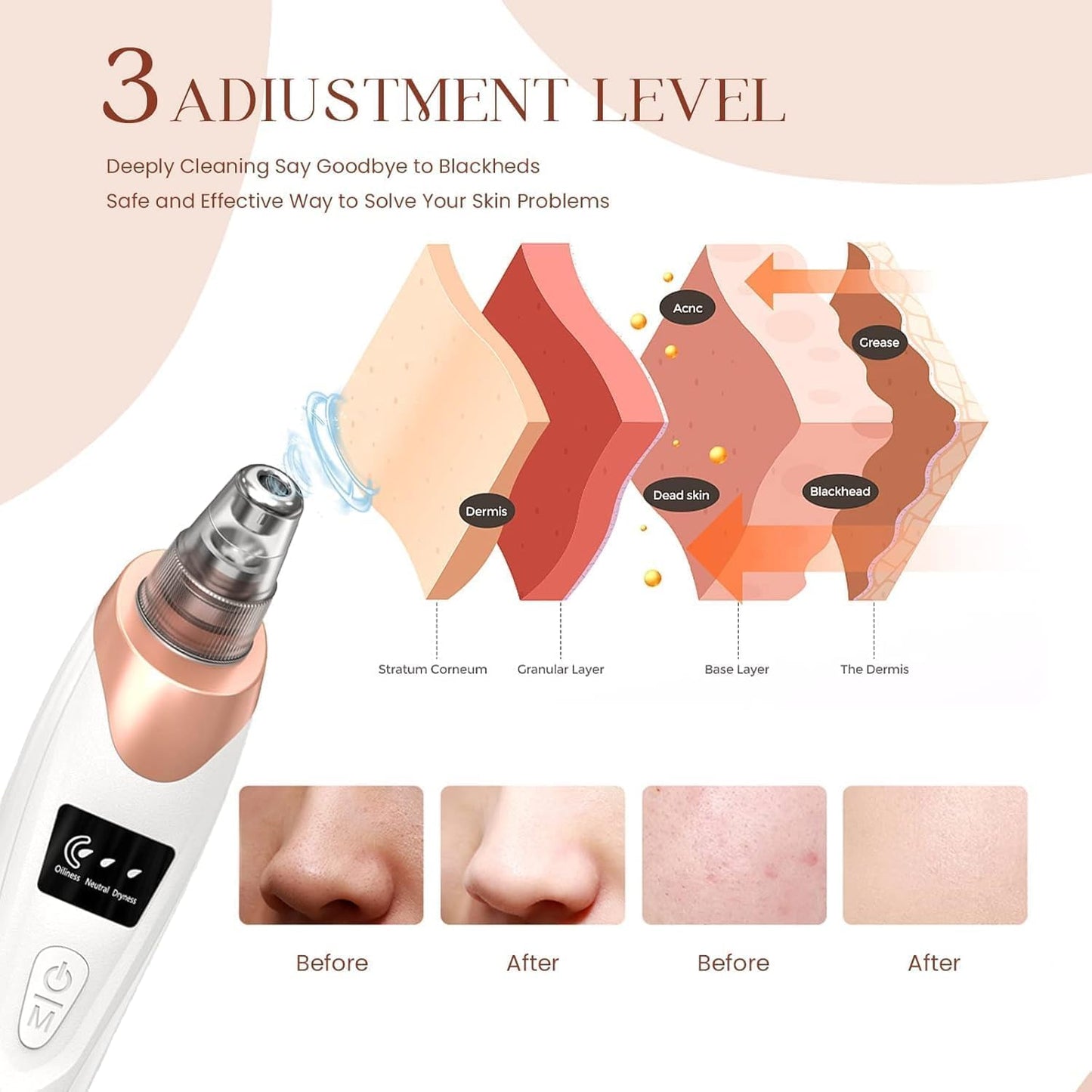 5-in-1 Blackhead Remover Machine – Electric Pore Cleaner & Whitehead Removal Tool, Deep Face Cleaner Machine for Acne, Pimple & Blackhead Removal, USB Rechargeable Derma Suction Device (Blackhead remover)